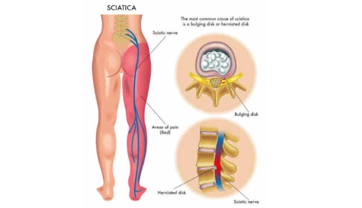 My Back Pain Coach Review. Is It a Scam?